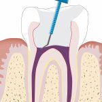 Zahnarzt Erlangen Wurzelbehandlung