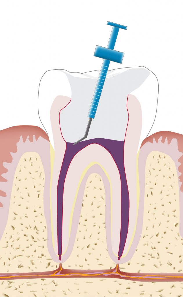 Zahnarzt Erlangen Wurzelbehandlung